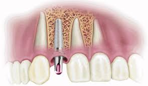 Lựa chọn kỹ thuật làm răng sứ implant giá bao nhiêu